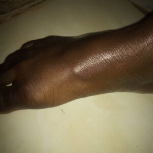 Jinja extract treatment on arthritis 